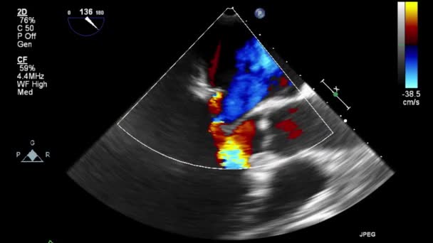 Ультразвуковое Трансофагеальное Исследование Сердца — стоковое видео