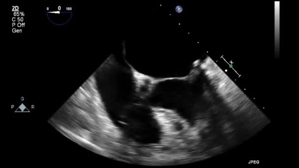 Ultrasound Transesophageal Examination Heart — Stock Video