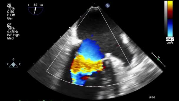 Kalbin Ultrason Transsofageal Muayenesi — Stok video