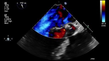 Kalbin ultrason transsofageal muayenesi.