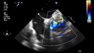 Kalbin ultrason transsofageal muayenesi.