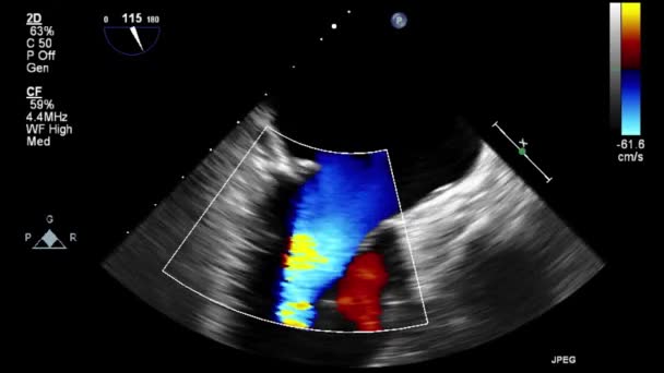 Ecografia Esame Transesofageo Del Cuore — Video Stock