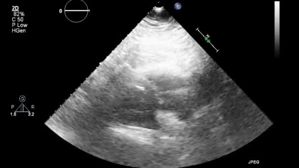 Ultraljudstransesofageal Undersökning Hjärtat — Stockvideo