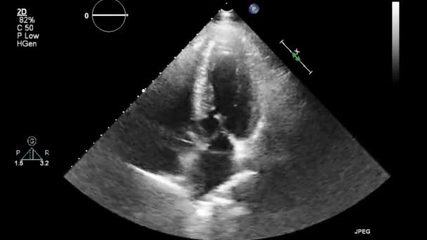 Ultrasound Transesophageal Examination Heart — Stock Video