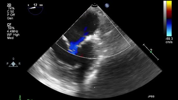 Ultraschall Transesophageale Untersuchung Des Herzens — Stockvideo