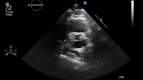 Echografie Transslokdarmonderzoek Van Het Hart — Stockvideo