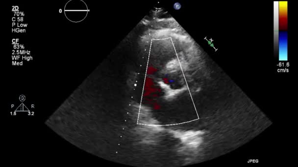 Echografie Transslokdarmonderzoek Van Het Hart — Stockvideo