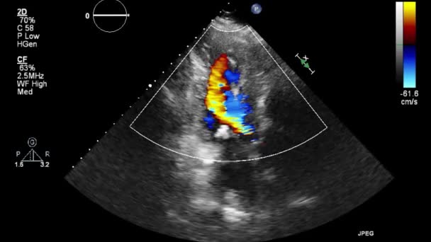 Echografie Transslokdarmonderzoek Van Het Hart — Stockvideo