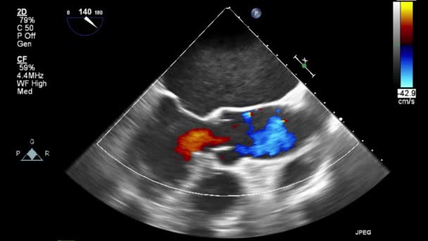 Ultrasound Transesophageal Examination Heart — Stock Video