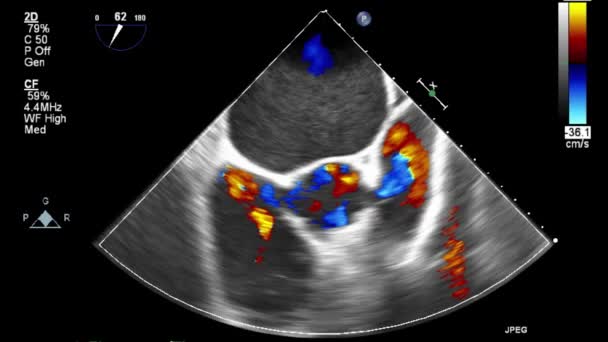 Exame Transesofágico Ultrassonográfico Coração — Vídeo de Stock