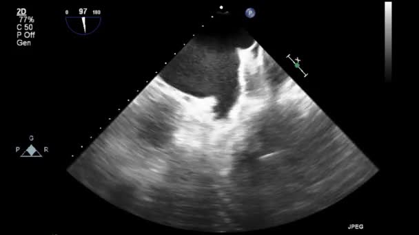 Echografie Transslokdarmonderzoek Van Het Hart — Stockvideo