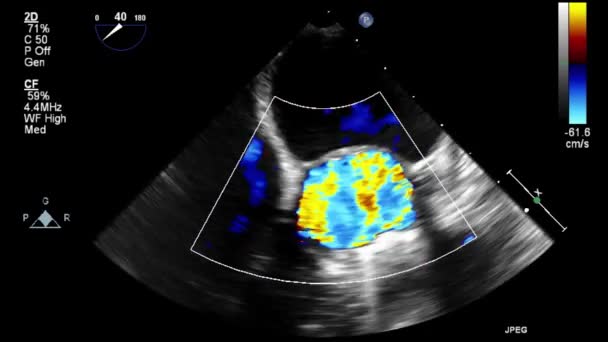 Kalbin Ultrason Transsofageal Muayenesi — Stok video