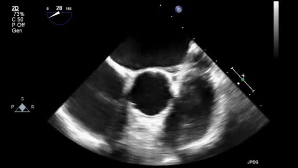 Echografie Transslokdarmonderzoek Van Het Hart — Stockvideo