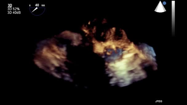 Ultrasound Transesophageal Pemeriksaan Jantung — Stok Video