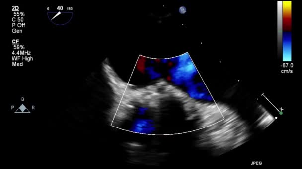 Echografie Transslokdarmonderzoek Van Het Hart — Stockvideo