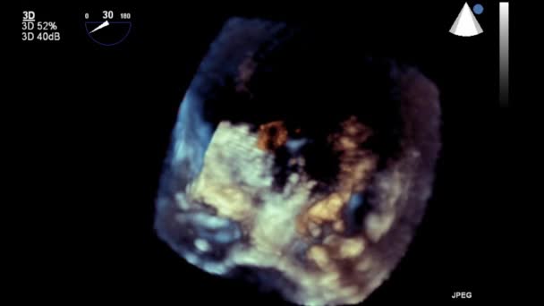 Examen échographique transœsophagien du cœur .