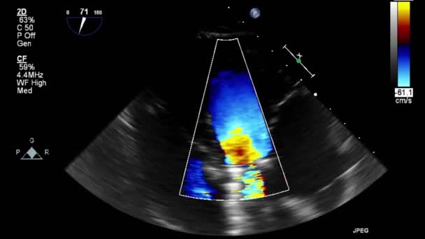 Echografie Transslokdarmonderzoek Van Het Hart — Stockvideo