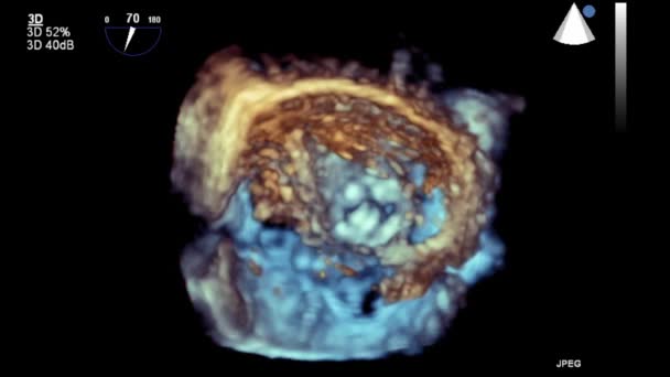 Ultrasound Transesophageal Examination Heart — Stock Video