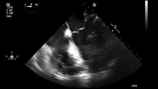 Ultrasound Transesophageal Examination Heart — Stock Video