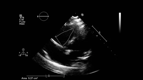 Afbeelding Van Het Hart Grijs Schaal Modus Tijdens Transesofageale Echografie — Stockfoto