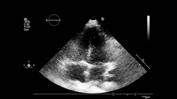 Transesofageal Ultrason Sırasında Kalbin Gri Ölçekli Görüntüsü — Stok fotoğraf