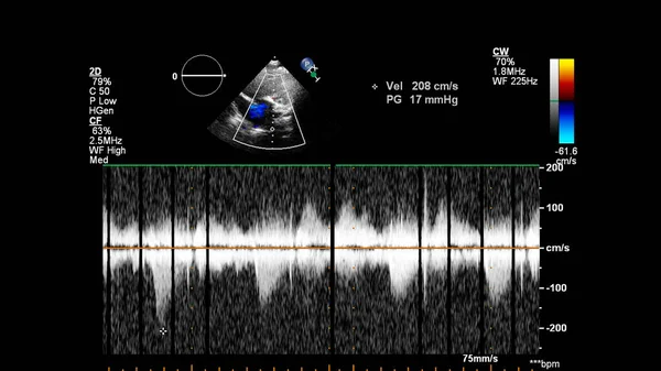 Transesofageal Ultrason Sırasında Doppler Kipi Ile Kalbin Görüntüsü — Stok fotoğraf