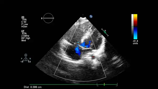 Image Cœur Lors Une Échographie Transœsophagienne Mode Doppler — Photo