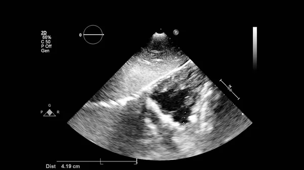Изображение Сердца Сером Режиме Время Трансофагеального Ультразвука — стоковое фото