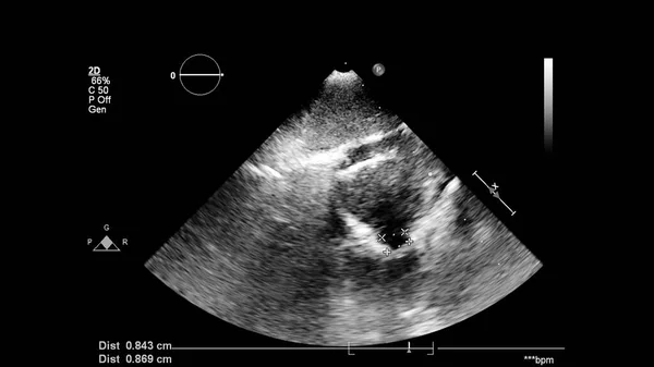 Afbeelding Van Het Hart Grijs Schaal Modus Tijdens Transesofageale Echografie — Stockfoto