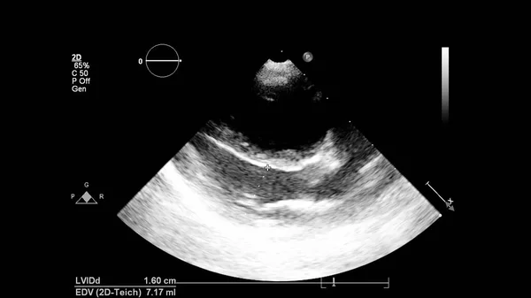 经食管超声下灰度型心脏影像学 — 图库照片