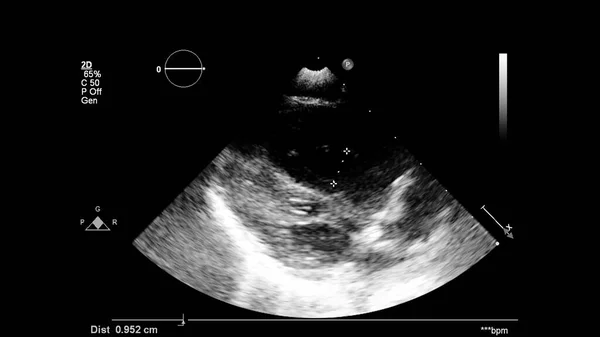 Image Heart Gray Scale Mode Transesophageal Ultrasound — Stock Photo, Image