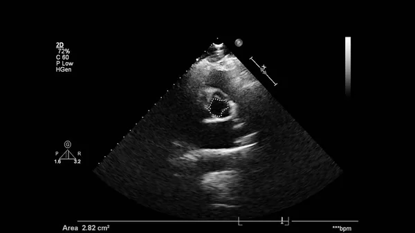 Image Heart Gray Scale Mode Transesophageal Ultrasound — Stock Photo, Image