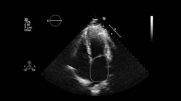 経食道超音波検査時のグレースケールモードで心臓の画像 — ストック写真