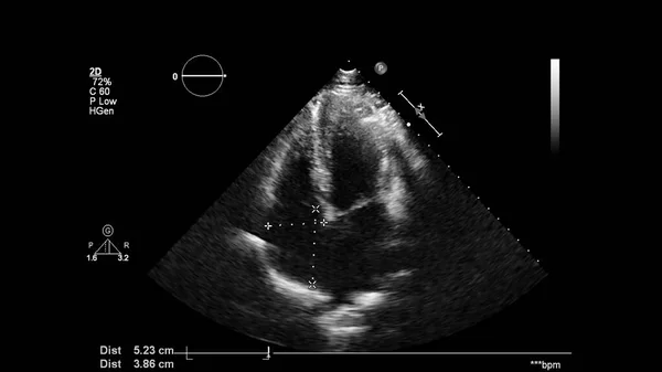 経食道超音波検査時のグレースケールモードで心臓の画像 — ストック写真