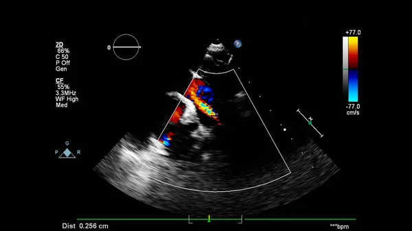 Immagine Del Cuore Durante Ecografia Transesofagea Con Modalità Doppler — Foto Stock