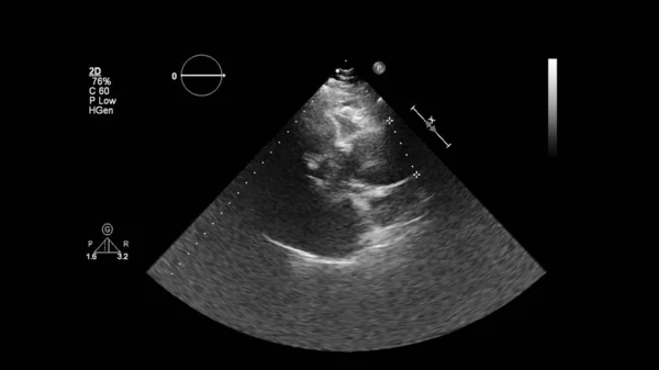 Transesofageal Ultrason Sırasında Kalbin Gri Ölçekli Görüntüsü — Stok fotoğraf