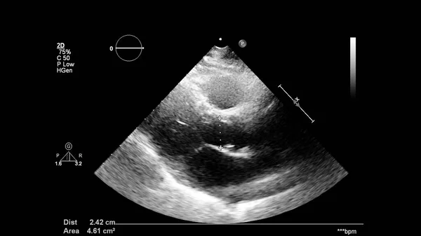 経食道超音波検査時のグレースケールモードで心臓の画像 — ストック写真