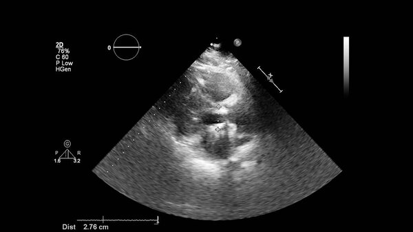 Изображение сердца в сером режиме во время трансофагеального ультразвука.