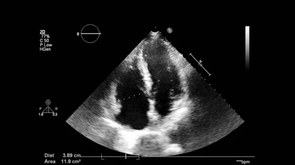 Transesofageal Ultrason Sırasında Kalbin Gri Ölçekli Görüntüsü — Stok fotoğraf