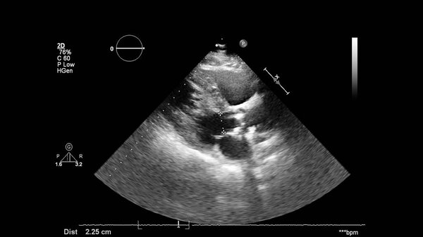 Изображение сердца в сером режиме во время трансофагеального ультразвука.