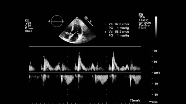 经食管超声下灰度型心脏影像学 — 图库照片