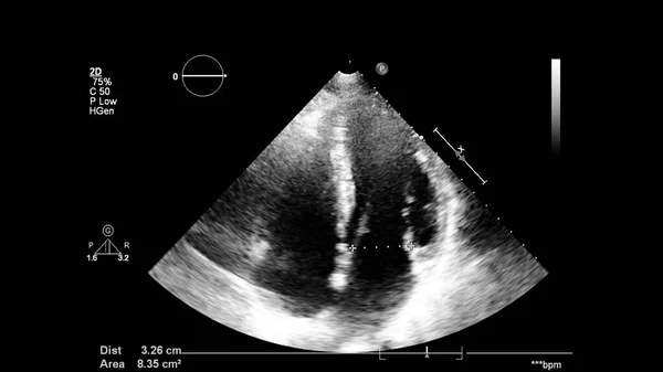 Transesofageal Ultrason Sırasında Kalbin Gri Ölçekli Görüntüsü — Stok fotoğraf