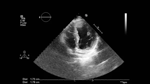 Transesofageal Ultrason Sırasında Kalbin Gri Ölçekli Görüntüsü — Stok fotoğraf