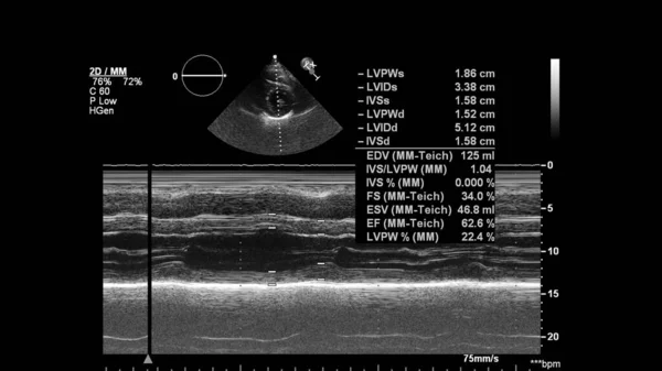 Image of the heart in gray-scale mode during transesophageal ultrasound.