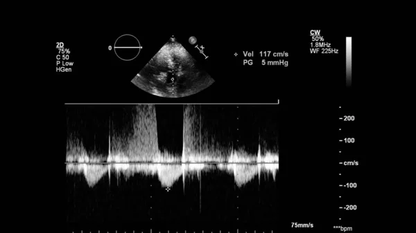 Kép Szív Szürke Skála Mód Során Transesophagealis Ultrahang — Stock Fotó