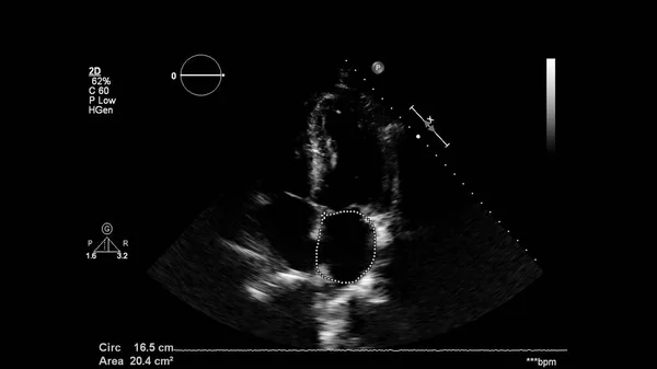 Afbeelding Van Het Hart Grijs Schaal Modus Tijdens Transesofageale Echografie — Stockfoto