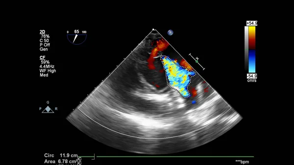 Obrázek Srdce Během Transesofageálního Ultrazvuku Dopplerovým Módem — Stock fotografie