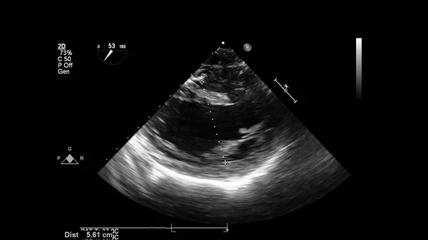 Transesofageal Ultrason Sırasında Kalbin Gri Ölçekli Görüntüsü — Stok fotoğraf