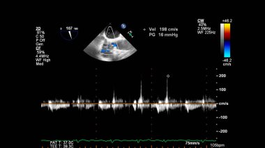 Transesofageal ultrason sırasında Doppler kipi ile kalbin görüntüsü.
