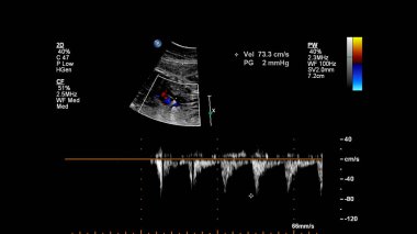 Fetal ekokardiyografi ile ultrasonografi ekranı.